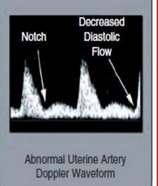 Uterin arter dopler Plasentasyon kusurlu ise yüksek direnç devam eder UtA dopler ile patolojik akım bulguları ile yüksek riski olguların önemli bir kısmı tespit