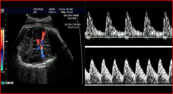 IUGR Hipoksi MCA Normal fetus düşük