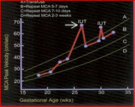 MCA Doplere Göre Fetal Anemi Tedavisi Zone A Tedavi Zone B.