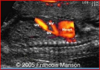 nedeniyle kolayca görüntülenir Revers DV(DV RAV) atrial dalgası perinatal mortalite,