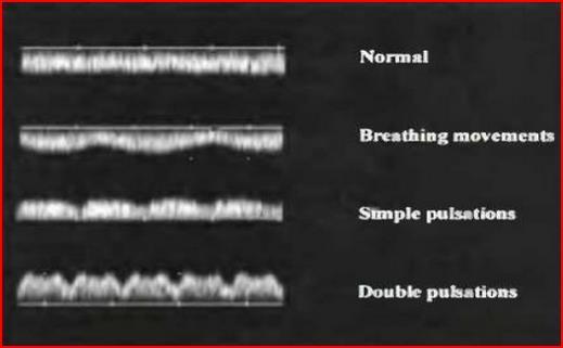 Umblikal Ven Doppler Monofaziktir, akım hızı ortalama 15cm/saniye 2/3 trimesterde pulsatil UV kardiak anomali, taşiaritmi ve kongestif kalp