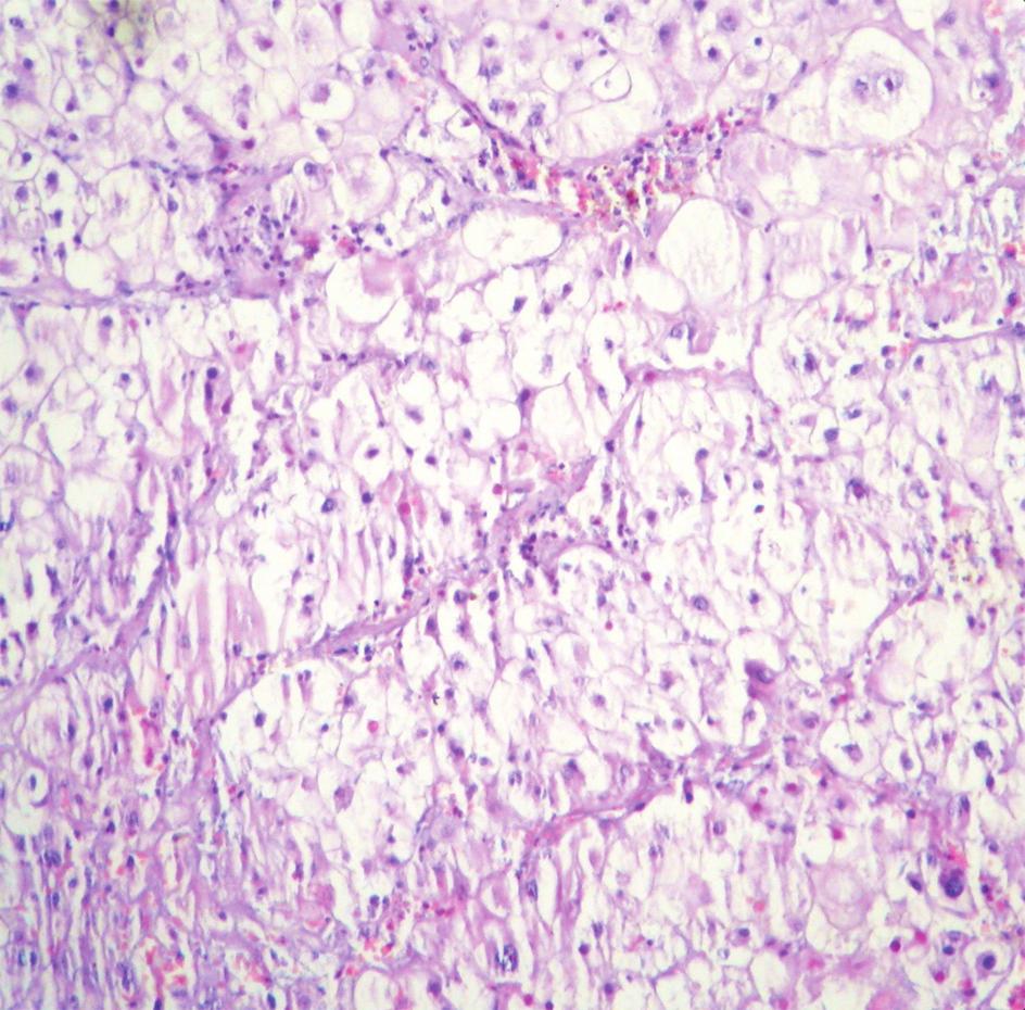 241 A, sinaptofizin ve nörofilaman gibi nöronal belirteçler, GFAP gibi glial belirteçler, HMB 45 ve Melan A gibi melanositik belirteçler ile genellikle negatif sonuç vermektedir.