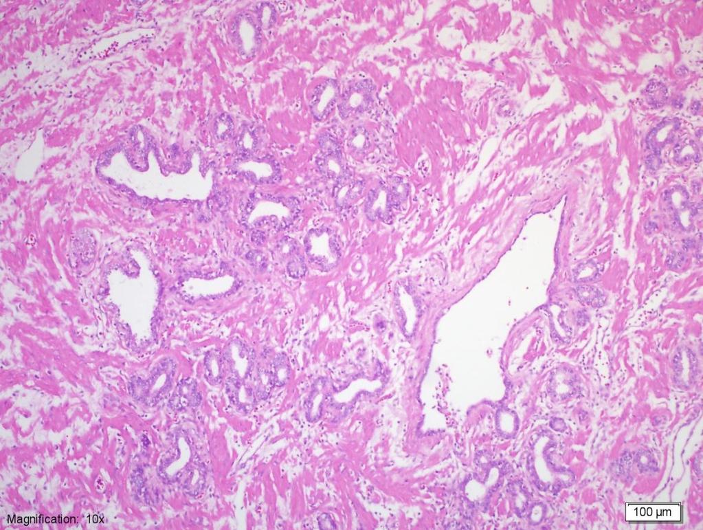 Resim 3: Postatrofik hiperplazi odağı, santral duktus çevresine dizelenmiş hiperplazik, atrofik glandlar (H&E 100x) 2.4.