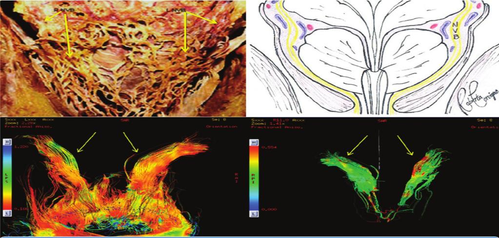 A B C Şekil 1. Prostatın koronal kesitte görüntüsü. (A) Histopatolojik kesitte prostat posteriorda NVB seyri. (B) Anatomik çizim ile NVB seyri.