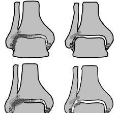 22 Acta Orthop Traumatol Turc Suppl En belirgin fizik bak bulgusu, anterolateral eklem aral duyarl l d r.