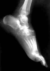 Sonuçlar De erlendirme topallama, a r varl, radyografik ölçümler ve AOFAS (American Orthopaedic Foot and Ankle Society) skorlama sistemine göre yap ld.