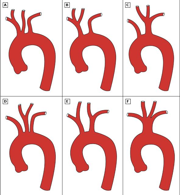 Distal ya da posterior ark ise sol subklavian arter ve ligamentum arteriosum arasında yer alır (8, 9).