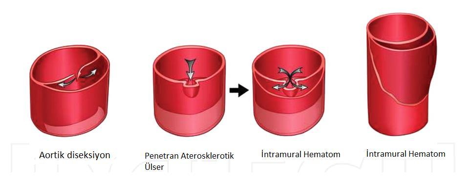 2.5. Diğer Torakal Aort Hastalıkları 2.5.1 Penetran ateroskleroitk Ülser Penetran aterosklerotik ülser, aterom plağının ülserasyonu şeklinde tanımlanabilir.