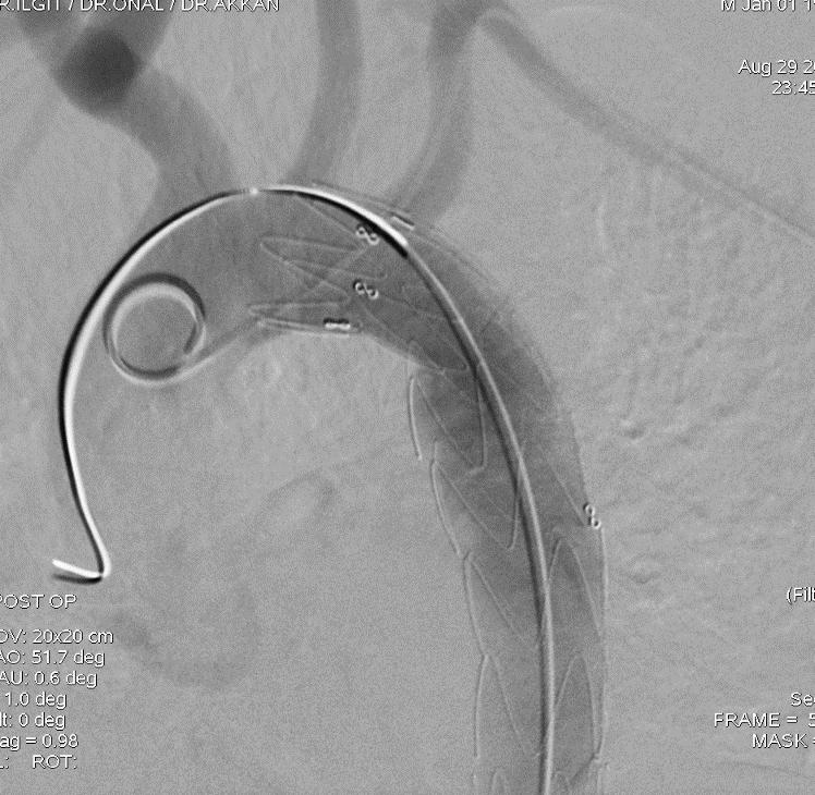 aortik istmus yerleşimli transeksiyon alanı