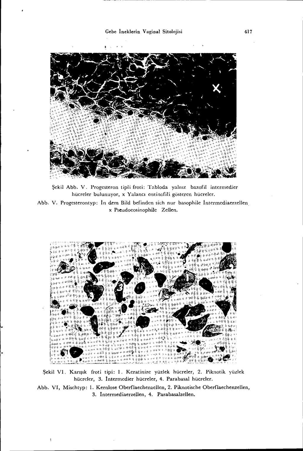 Gebe lneklerin Vaginal Sitolojisi 417 Şekil Abb. V. Progesteron tipii froti: Tabloda yalnız bazofi! intcrmedier hücreler bulunuyor, x Yalancı eazinafili gösteren hücreler. Abb. V. Progesterontyp: In dem Bild befinden sich nur basophile lntermediaerzellen x Pseudocosinophilc ZeIlen.