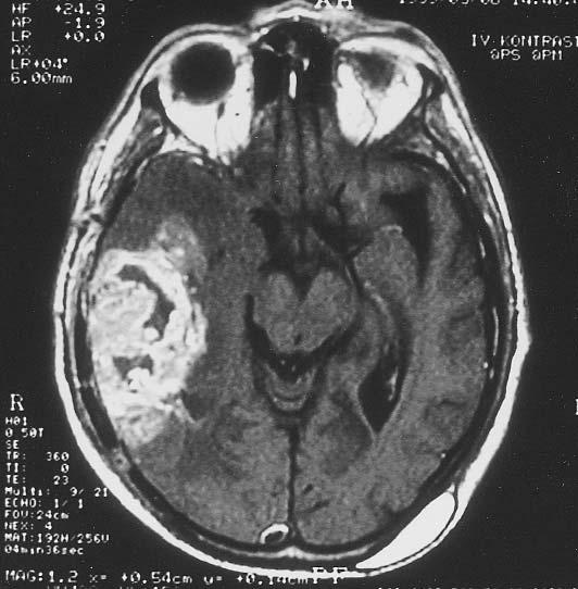 GİRİŞ Glioblastoma multiforme (GBM) santral sinir sisteminin yüksek malignite gösteren, tüm yaş grublarında oldukça sık olarak gözlenen bir tümörüdür(11).