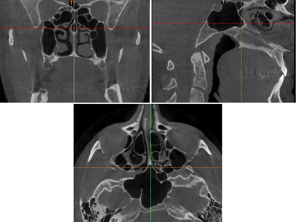 b) Septum Pnömatizasyonu Nazal septumun posterosüperiorunda pnömatizasyon görülmesidir. Sfenoid sinüsün septumun posterosüperioruna doğru pnömatizasyonu sonucu oluşur (Şekil 2. 18) (94, 95). Şekil 2.