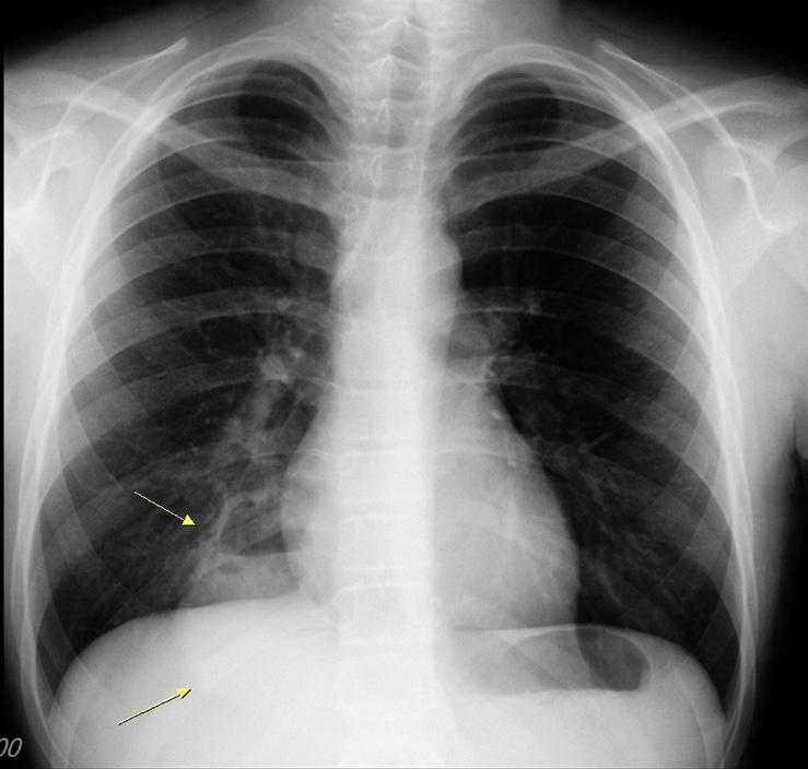 Akciğer apsesi tanısı hemen her zaman görüntüleme ile yapılır. Çoğu vakada akciğer apsesinin tanımlanmasında direk grafi yeterlidir.