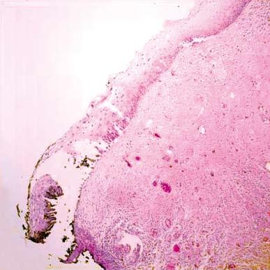 yeşil c et al: Premalignant Lesions of the Cervix yorumlandığı saptandı (Şekil 1A-D).