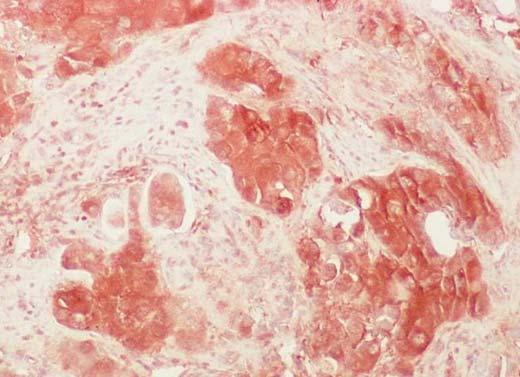 Resim 3: Skuamöz hücreli karsinomda yaygın ve kuvvetli sitoplazmik p65 ekspresyonu (Streptavidin-biyotin peroksidaz, x 100).