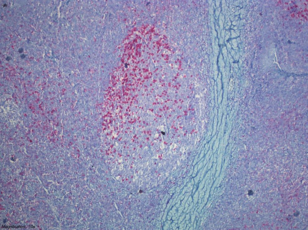 Resim 8: Tonsil folikülünde