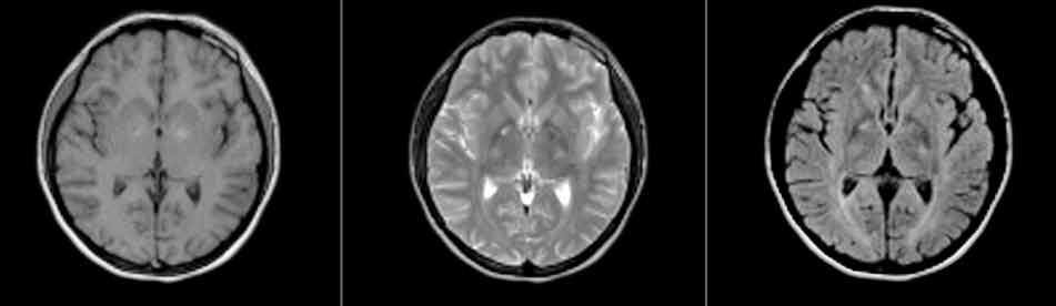 14 Parkinson Hast Hareket Boz Der Şekil 2. Hastanın dört ay sonraki beyin manyetik rezonans görüntüleri. baş ağrısı, bulantı ve senkop görülebilir.