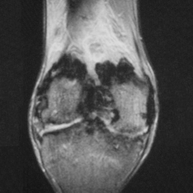 Diz Eklemi: Sinovya 465 Resim 13.,. Hemofilik artropati.