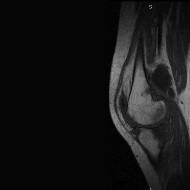 Femur ve tibianın ekleme bakan yüzlerinde erozyonlar ile birlikte, GRE T2* sekansta paramanyetik etkiye bağlı belirgin sinyal kaybı ile ortaya konan hemosiderin içeren sinovyal sıvı.