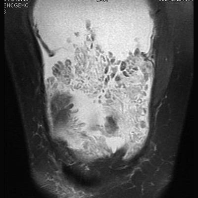 Diz MRG: () T1 sagittal, (, C) ksiyal ve koronal