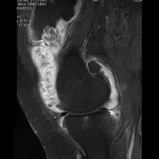 birlikte suprapatellar bursa içinde tüm sekanslarda