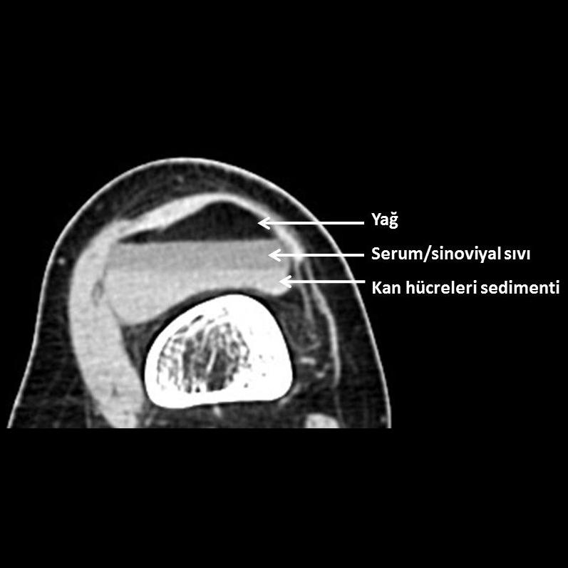 ncak tek bir sıvı-sıvı seviyelenmesi, hemorajik sıvının hücresel ve serum bileşenlerine ayrılmasını temsil edebilir.