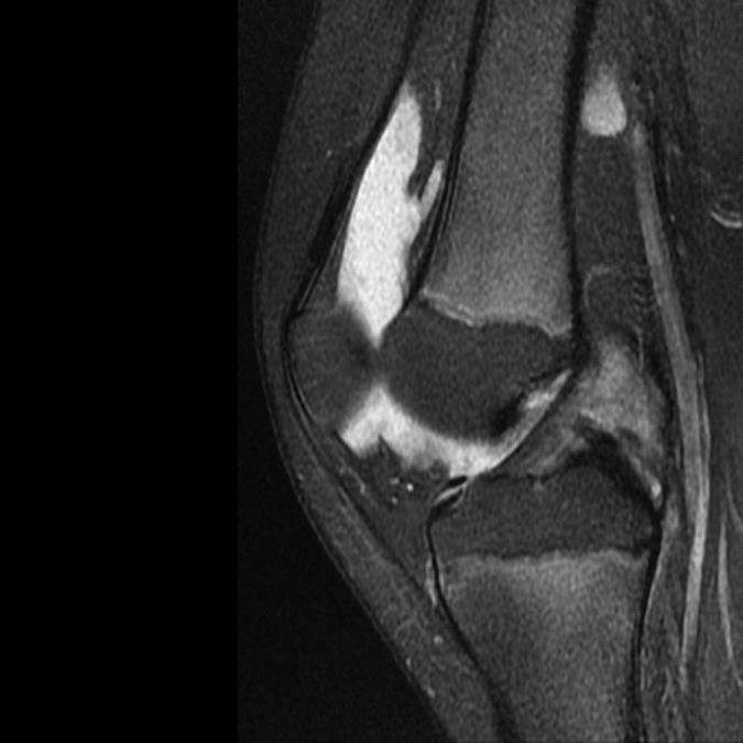 () Sagittal T1, () Yağ baskılı PD görüntülerde diz eklemi içinde sıvı ve T1 seride, sıvıya kıyasla hafif yüksek, ara sinyale sahip sinovyal