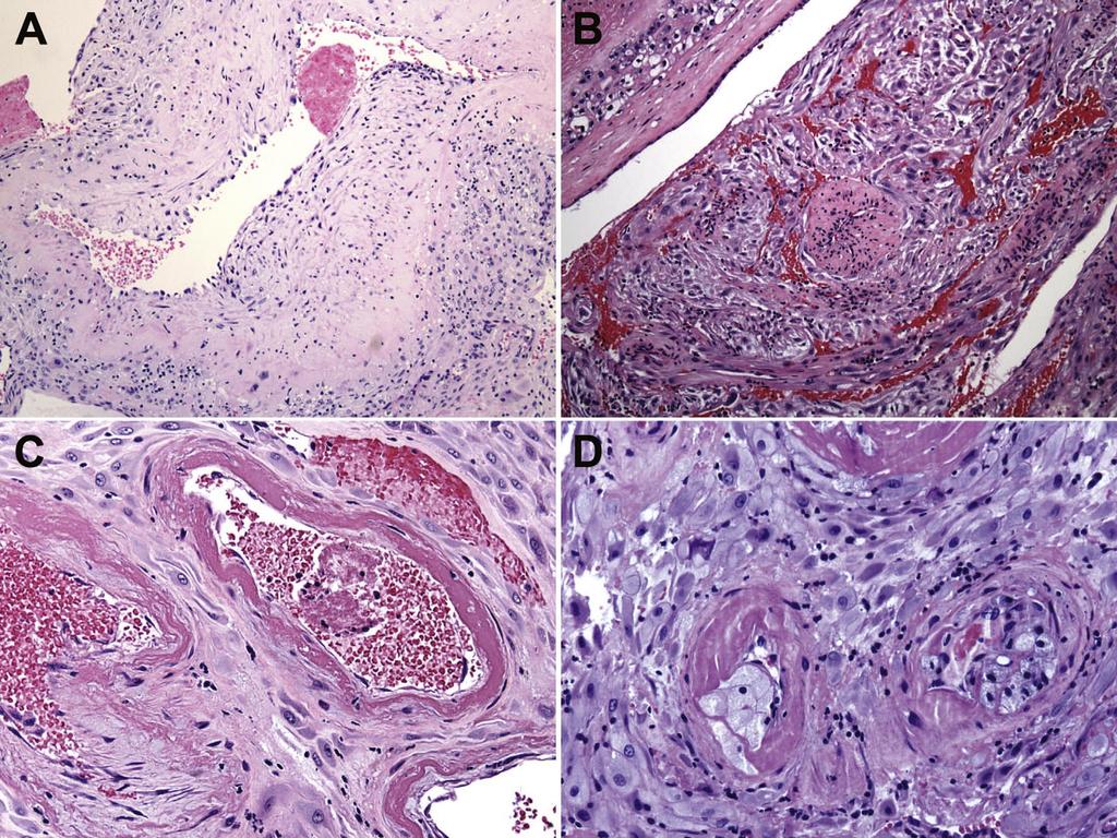Lesions of maternal malperfusion : decidual vasculopathy. (A) Persistence of muscularized basal plate arteries. (B) Mural hypertrophy of a membrane arteriole.