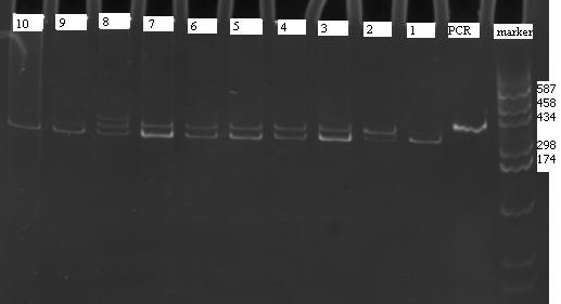 Kodon 12 de mutasyon olmayan örneklerde 355, 35, 30 bç uzunluğunda üç bant elde edilirken mutasyon saptanan örneklerde 385 ve 35bç uzunluğunda iki bant elde edildi.