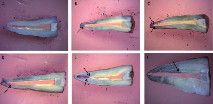 ile yıkandı. Kanallar en son serum fizyolojik ile yıkama işleminin ardından kâğıt kon (Protaper Universal Paper Points, Dentsply Maillefer, Ballaigues, İsviçre) kullanılarak kurulandı.