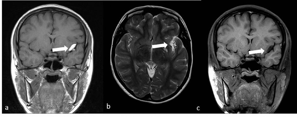 Resim 3: Sol silvian fissürde koronal T1-ağırlıklı görüntüde (a) ve aksiyel T2-ağırlıklı görüntüde (b) yüksek sinyalli, koronal yağ baskılı T1-ağırlıklı görüntüde (c) düşük sinyalli olarak izlenen