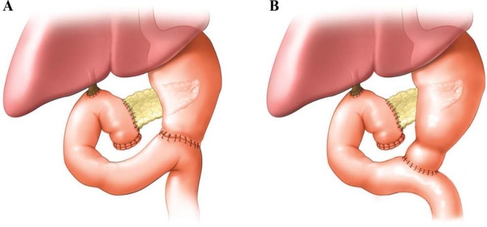37 invajinasyon ve duktomukozal anastomoz kombine edilir. 4 adet transpankreatik sütür pankreası anteriordan postariora doğru tam kat geçecek şekilde posteriordan çıkarılır.