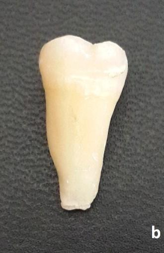 Örneğin Kök Kanalının Şekillendirilmesi C1 konfigürasyonuna sahip mandibular molar dişin giriş kavitesi elmas bir frez yardımı ile açılmıştır.