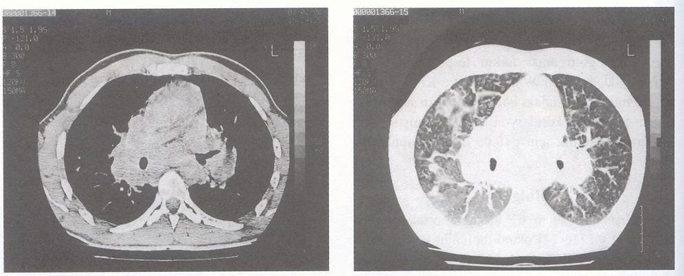 Taci Hoca ve ark. Göüs Hastalıkları Resim 2. Aynı olguda toraks BT mediastinal kesitinde bilateral hiler ve mediastinal lenfadenopati. Resim 3.