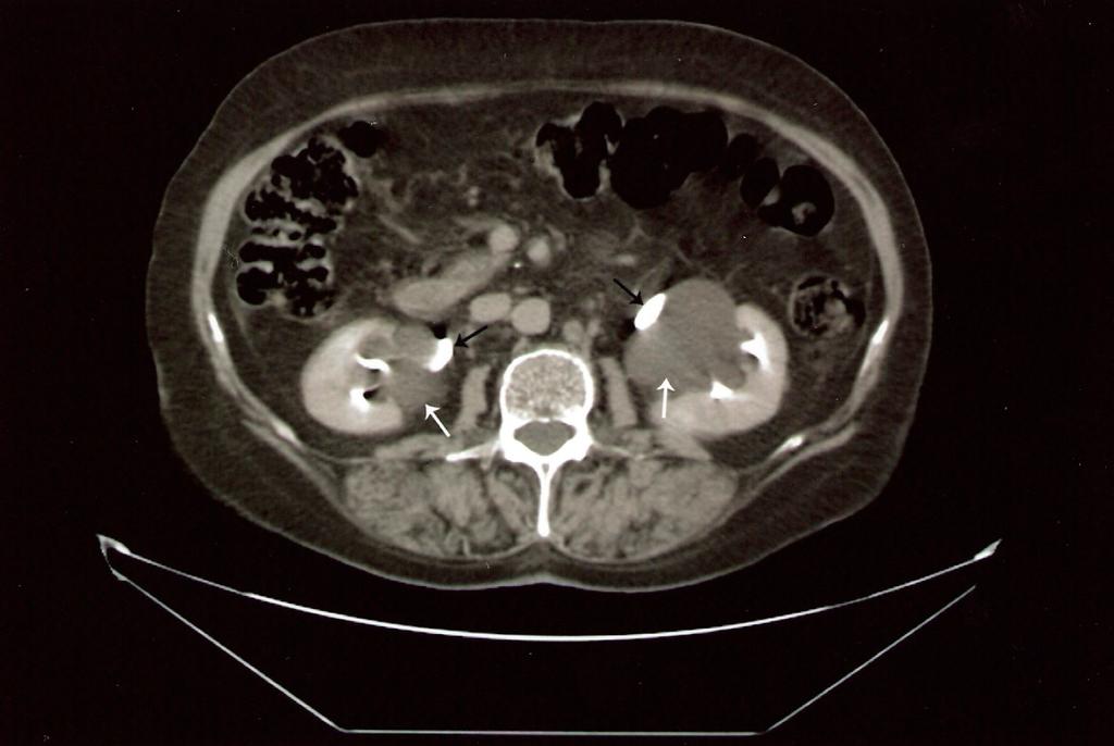 DOĞUMSAL LENFANJİYOMATOZİS (Congenital Lymphangiomatosis) telerinin arttığı anlaşıldı (Resim 4). Bu bulgularla lenfanjiyomatozis olduğu düşünüldü. Hastaların hiçbirinde üriner sistemde taş görülmedi.