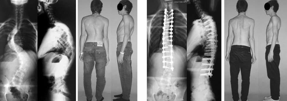 Şekil-2. CM I, 17 yaşında erkek hasta. Suboksipital dekompresyon ve duraplasti uygulandıktan 24 ay sonra T2-L3 posterior spinal füzyon ve enstrümantasyon uygulandı.