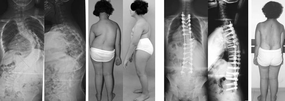 Şekil-3. Tethered kord, T8-9 ve L1 hemivertebra, kelebek vertebrası bulunan 13 yaşında kadın hasta.