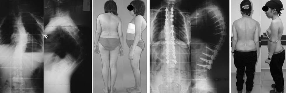 4, b. Preoperatif klinik görünümü, c. Postoperatif T6-T12: 28, d. Postoperatif klinik görünümü Şekil-4. Tethered kord, T7-11 kelebek vertebra, T9 hemivertebrası olan 15 yaşında kadın.