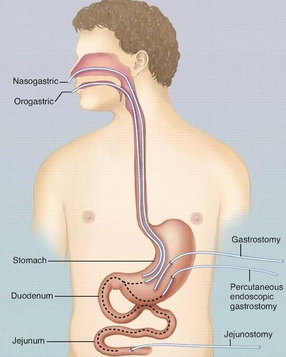 Enteral Nütrisyon Erişim Yolları Nazogastrik Orogastrik Mide