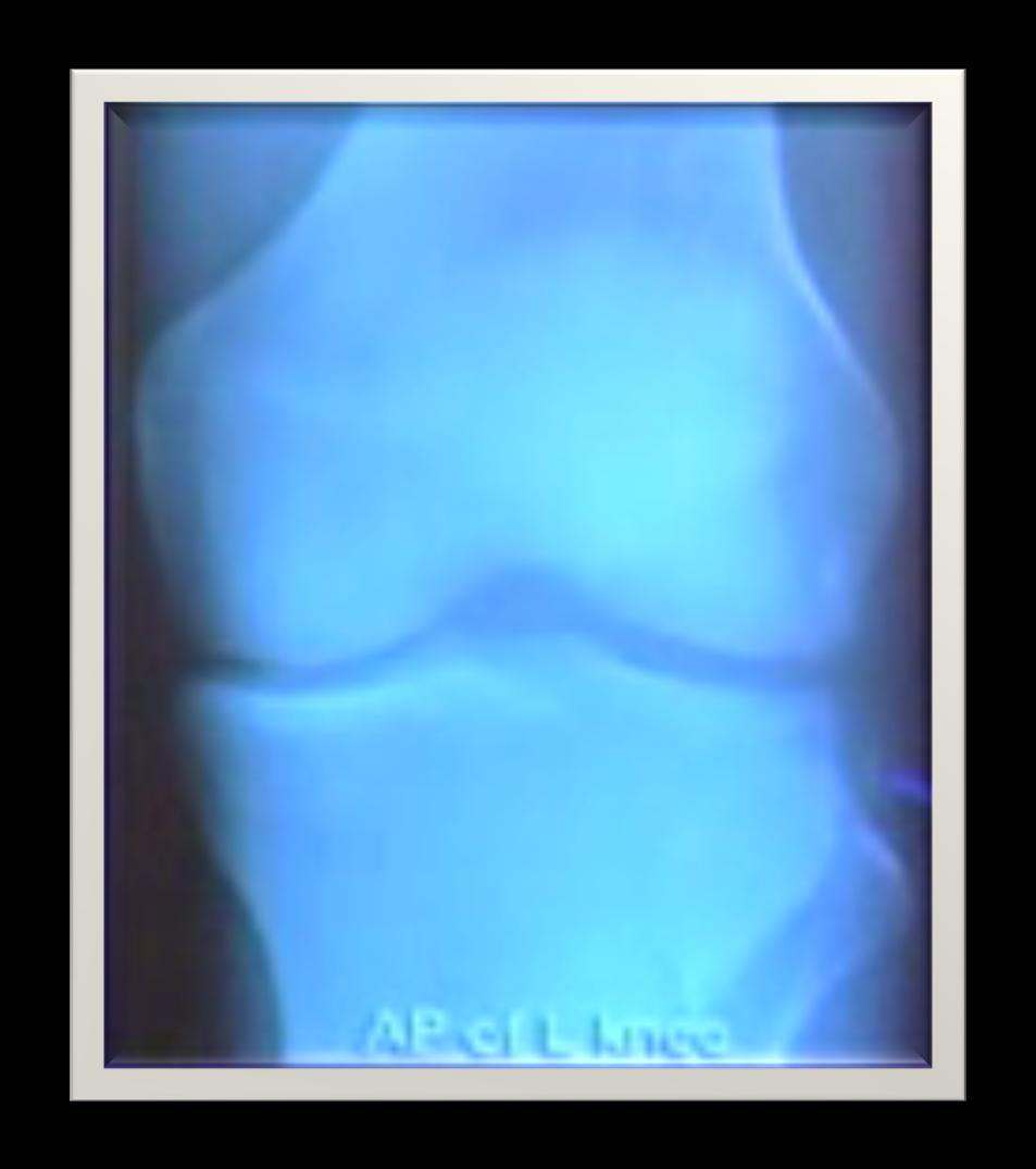 Patella dışındaki ekstansör mekanizma (kuadriseps veya patellar tendon) yaralanmalarında