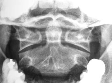 Atlas,odontoid çıkıntı ve aksisin süperior faseti