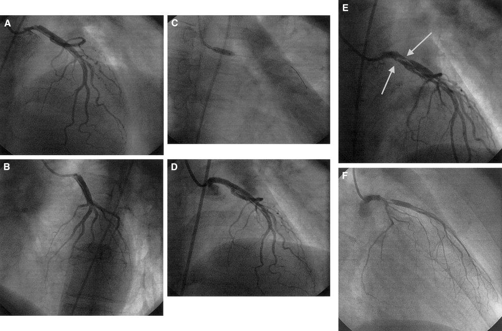 KILAVUZ KATETERE BAĞLI DİSSEKSİYON BAŞLANGIÇ YERİNE FOKAL STENT