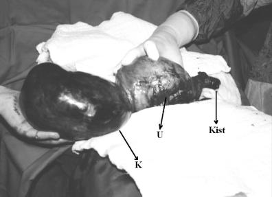 Perinatoloji Dergisi Cilt: 12, Say : 4/Aral k 2004 205 Resim 1: Operasyon s ras görüntü (K: Sa overde kitle, U: Uterus) de ise, kist duvar nda yüzeye yak n alanlarda eski ve yeni kanama alanlar, çok