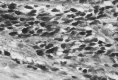 206 Hasan fiahiner ve ark., Gebelikte Bilateral Ovaryal Kitle: Bir Olgu Sunumu Resim 3: mmatür tümör hücre çekirdeklerinde nöron spesifik enolaz pozitifli i (NSEX-400).