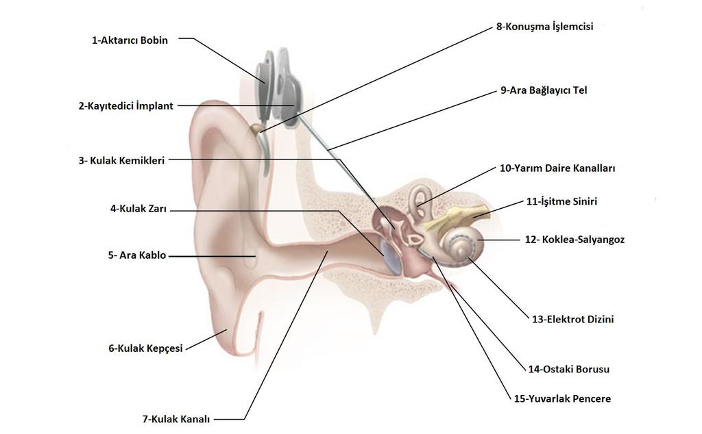 KULAĞIN YAPISI ve KOKLEAR İMPLANT ŞEMASI KOKLEAR İMPLANT NASIL ÇALIŞIR 1- Kulak üzerinde konuşma işlemcisindeki (8)mikrofon sesleri alır. 2- Bu sesler Kelime işlemcisinde (8) sinyal haline getirilir.