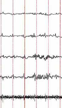 Evre N2 Uyku iğciği: 12-14 Hz lik (11-16 da olabilir) frekanstadır, yarım saniyeden uzun süren, en yüksek