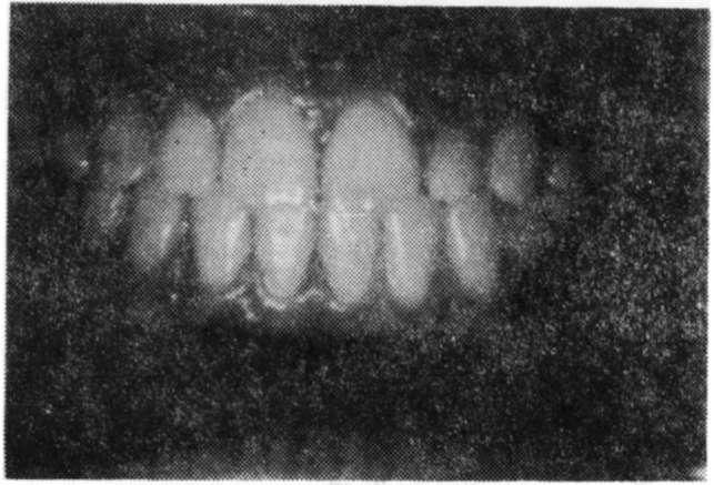 Anterior Openbite Tedavisi G.Ü. Dişhek. Fak. Der., 1996 Resim 9. Vakanın pekiştirme tedavisinden 2 yıl sonraki ağız içi görünümü. TARTIŞMA Şekil 3.