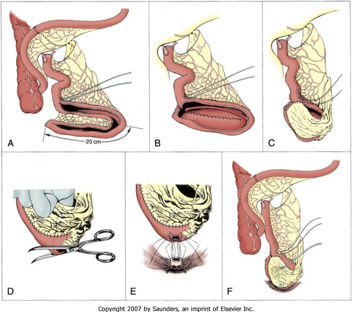 Üriner Diversiyon Şekilleri Figure 82-4 Construction of the ileal neobladder (Studer pouch) with an isoperistaltic afferent ileal limb.