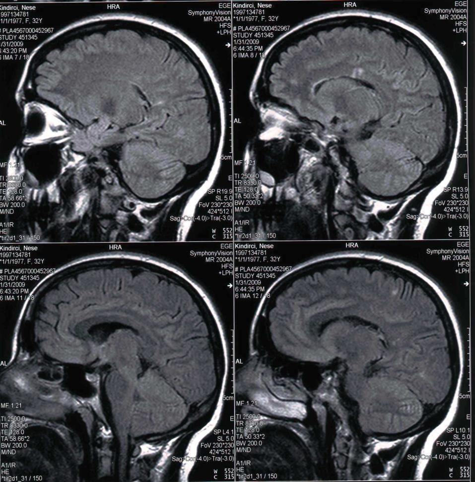 NK, 31 y bayan 2009 Sol optik nörit 2006 Sağ optik nörit 2007 Sol optik nörit Pulse kortikoterapi ile