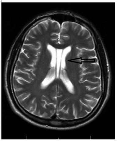 ŞEKİL 1. Manyetik rezonans beyin görüntülemesi (T2) ile olguda saptanan kavum vergae (aksiyal kesitte ok ile işaretli). ŞEKİL 2.
